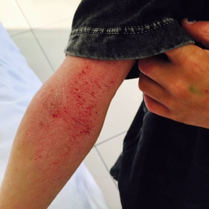 Red raw: The inside of Tyler Saunder's elbow affected by eczema.