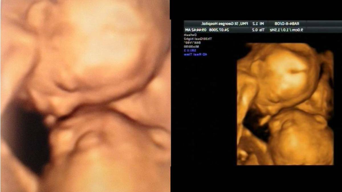 A Bunbury mother was given this photo of her unborn babies after a scan with a local business. The photo on the right is from Google Images.