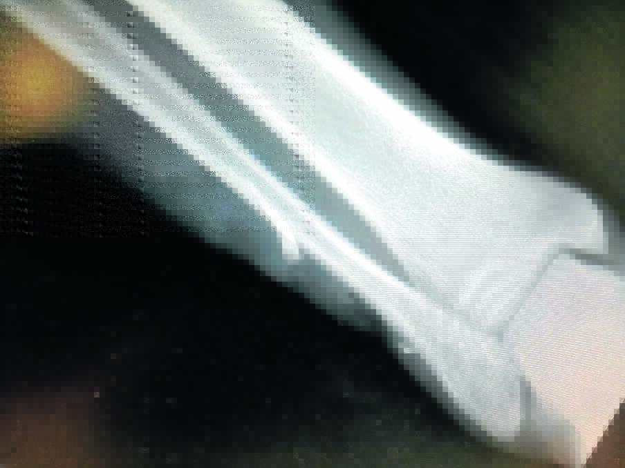 The X-ray showing the shark's tooth embedded in Alan Saunders' leg.